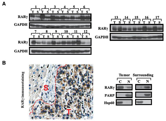 RARγ在癌組織與癌旁組織中的表達情況
